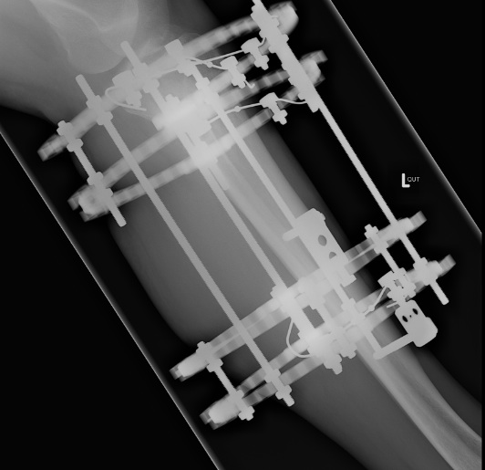 Ilizarov Proximal Tibia Lateral